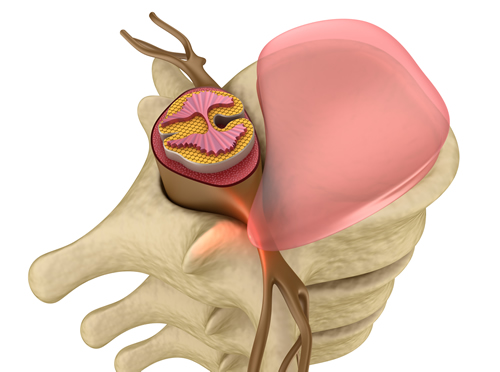 How Chiropractic Helps Heal A Bulging Disc