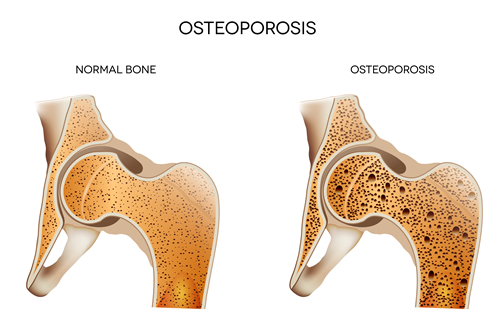 Osteoporosis vs. Osteopenia: What’s the Difference?
