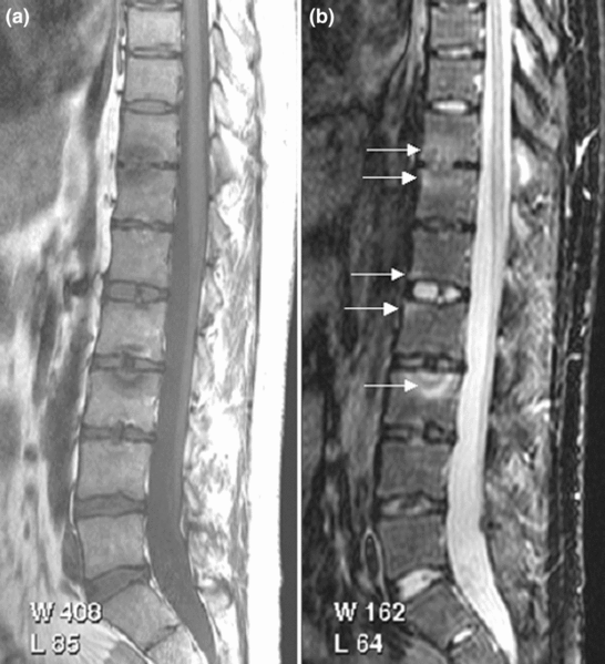 Ankylosing Spondylitis Spine Arthritis