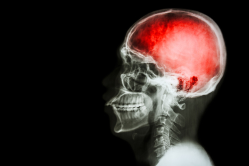 Mild Traumatic Brain Injuries
