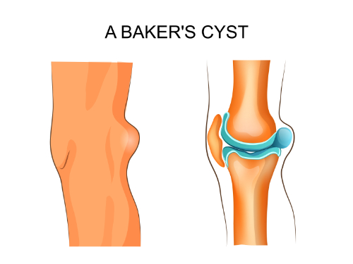 Baker’s Cyst: How Chiropractic Can Help Alleviate Its Pain
