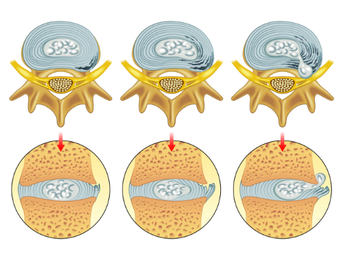 Herniated Disc