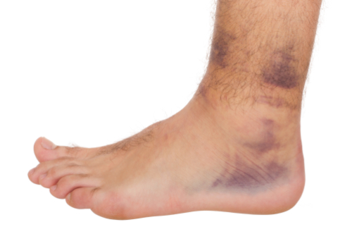 Sprain vs Strain: What’s the Difference?