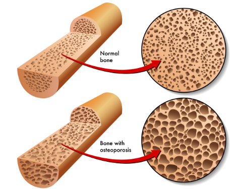 Osteopenia vs Osteoporosis